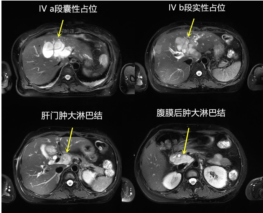 腹部ct:肝左葉佔位(35mm×47mm),肝左靜脈,門脈左支顯示不清,考慮受侵