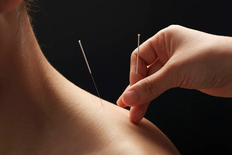 Acupuncture