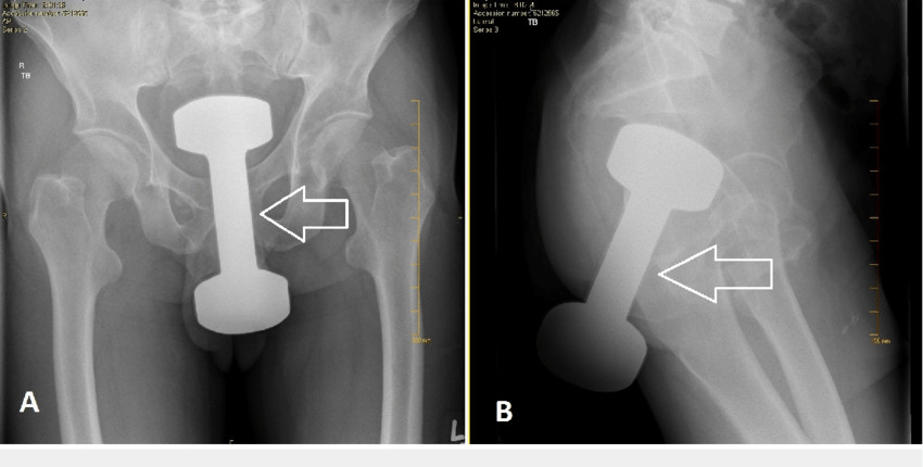 Rectal-dumbbell-arrow-on-abdominal-plain-films-A-antero-posterior-view-and-B.jpg