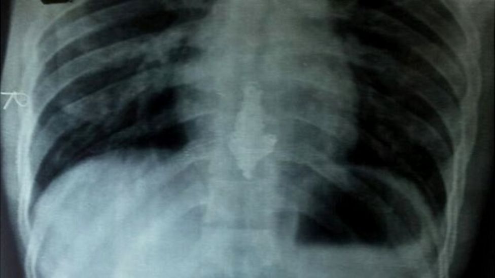 _82642653_x-ray1.jpg