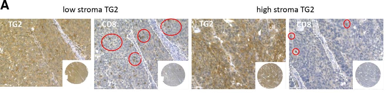 J Immunother Cancer 2021-Loss of host tissue transglutaminase boosts antitumor T cell immunity by altering STAT1STAT3 phosphorylation in ovarian cancer(1).jpg