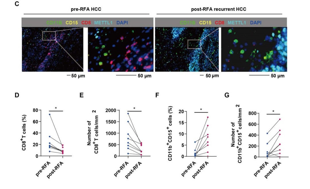 Hepatology - 2022 - Zeng - Eliminating METTL1‐mediated accumulation of PMN‐MDSCs prevents HCC recurrence after.jpg