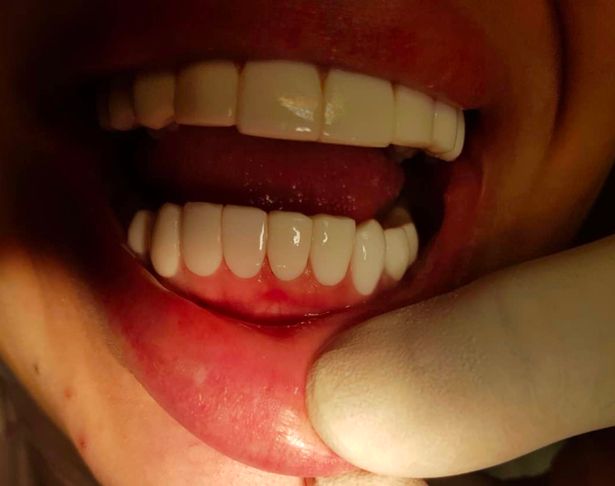 0_PAY-WOMAN-LEFT-HORRIFIED-AFTER-BOTCHED-TURKEY-TEETH (1).jpg