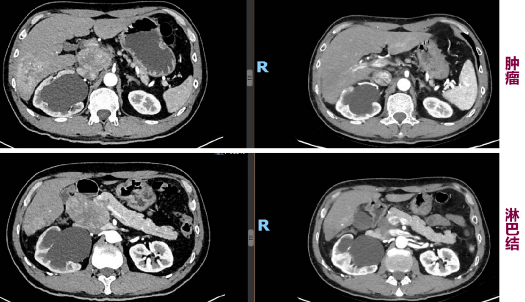 左右分別為治療前後腹部增強ct